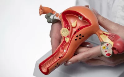 Endometriose: o que é, sintomas e a importância do diagnóstico por imagem